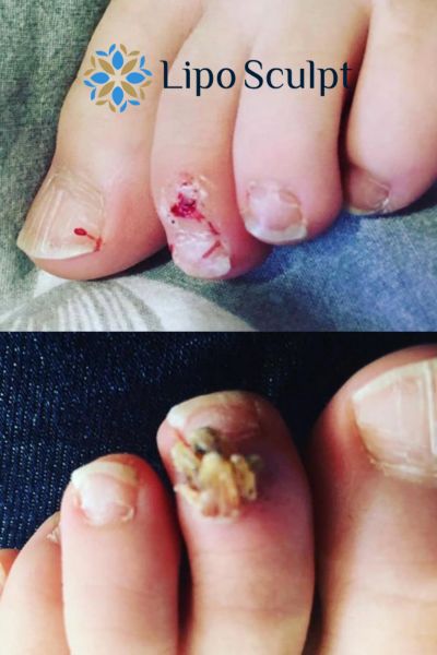 Wart removal customer results from Lipo Sculpt Tewkesbury